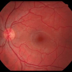 Retina normal retinal detachment