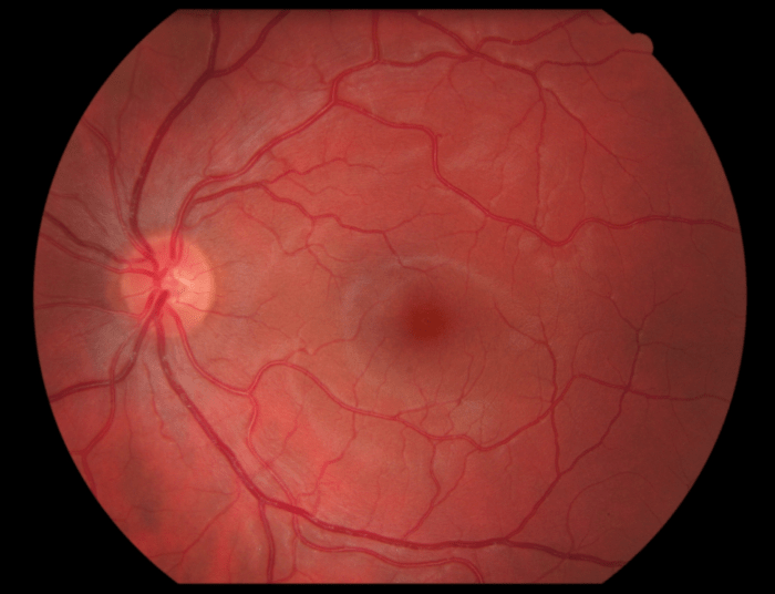 Retina normal retinal detachment